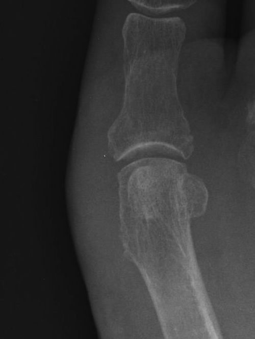 Hallux Valgus Post DSTP